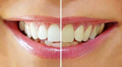 Teeth-Whitening Products Could Cause Bigger Problems Than Yellow Teeth